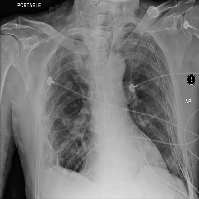 chest imaging Instance Segmentation Dataset (v7, 2024-07-21 12:56pm) by ...